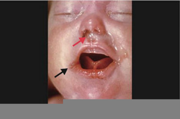 Rhagades Syphilis | Free Images at Clker.com - vector clip art online,  royalty free & public domain