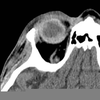 Vitreous Hemorrhage Mri Image