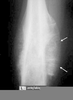 Sunburst Appearance Radiology Image