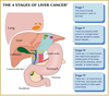 Liver Cancer Stages Image