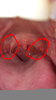 Palatopharyngeal Arch Bump Image