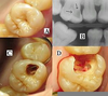 Early Caries Treatment Image