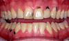 Teeth Blackening Cause Image
