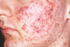 Acne Vulgaris Image