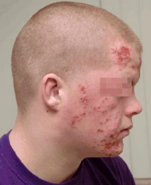 Aids Face Symptoms | F...