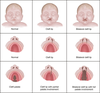 Cleft Palate Diagram Image