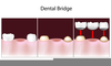 Dental Bridge Procedure Image