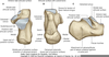 Calcaneus Fracture Anatomy Image