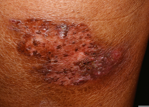 Pyoderma Vegetans Image
