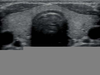Healthy Thyroid Ultrasound Image