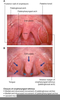 Palatopharyngeal Arch Inflammation Image