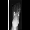 Lisfranc Fracture Club Image