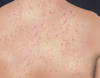 Mild Back Acne Image