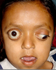 Turner Syndrome Eyes Image