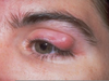 Stye Removal Image