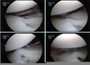 Torn Meniscus Repair Image