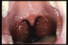 Acute Tonsillitis Image