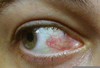 Herpes Eye Image