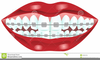 Mouth With Braces Clipart Image