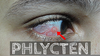 Phlyctenular Conjunctivitis Image