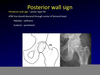 Posterior Wall Sign Image