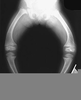 Rickets X Ray Image