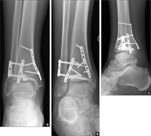 fracture ankle trimalleolar maisonneuve orif dorsiflexion surgical fractured mortise syndesmotic clker anteroposterior radiographs