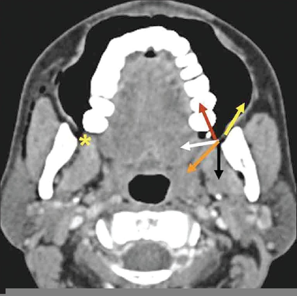 Retromolar Trigone Ct Free Images at vector clip art