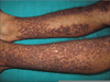 Blisters Legs Arms Image