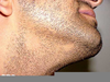 Alopecia Areata Beard Image