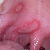 Blister Mouth Burn Image