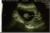 Gender Ultrasound Pictures Image