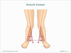 Knock Knees Surgery Image