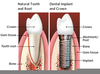 Dental Implant Molar Image