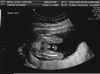 Ultrasound Pictures Boy Image