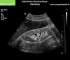 Glomerulonephritis Ultrasound Image