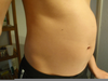 Bloated Belly Image
