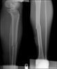 Leg Fracture Picture Image