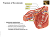 Clavicle Fracture Anatomy Image