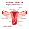 Vaginal Inflammation Image