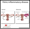 Pelvic Inflammatory Disease Image