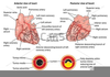 Heart Disease Clipart Image