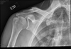 Broken Collarbone Bump Image