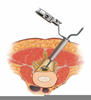Laminectomy Decompression Image