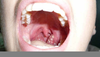 Inflamed Throat Image