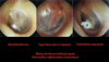 Tympanoplasty Scar Image