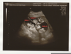 Identical Triplets Ultrasound Image