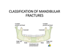 Mandibular Fracture Classification Image