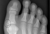 Fractured Toe Xray Image