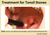Tonsil Stones Cure Image